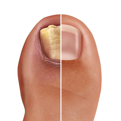 The Dermatologist Guide to Recognizing and Treating Toenail Fungus