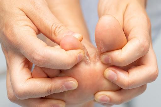 18 Tips for Treating Fungal Infection on Your Feet