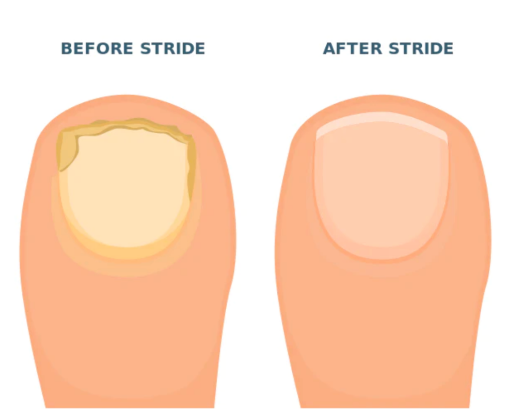 Toenail fungus remedy that actually works