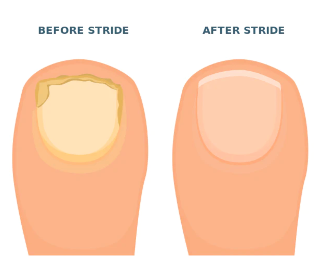 Toenail fungus remedy that actually works